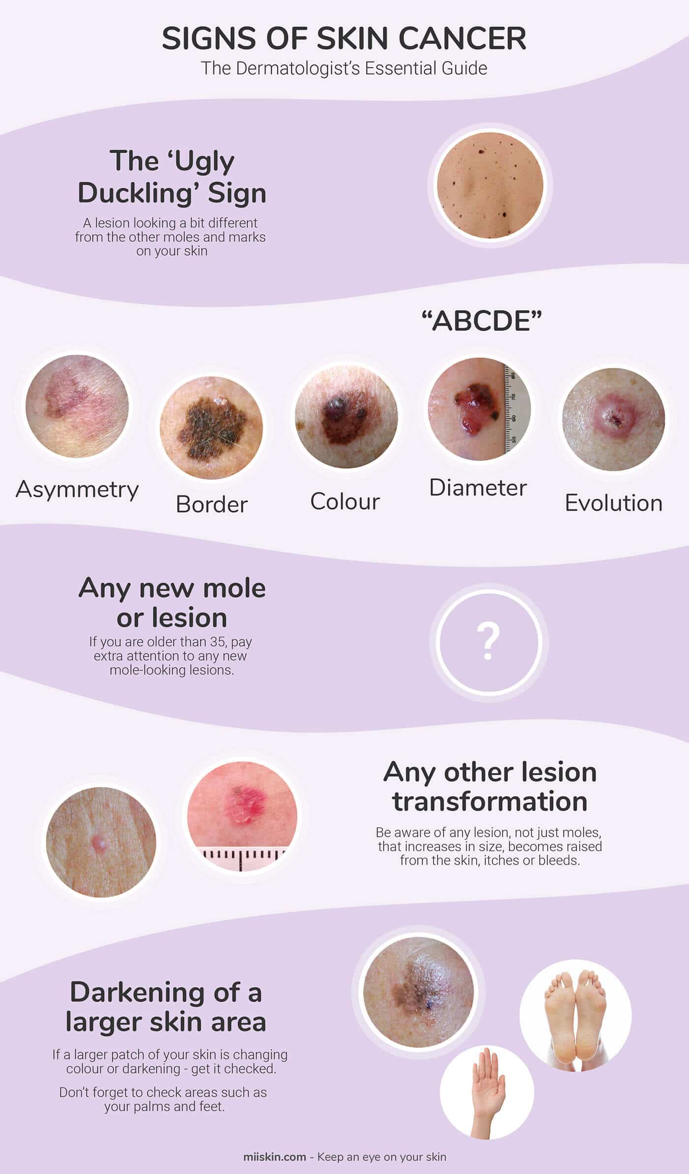 How to spot skin cancer